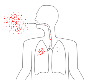 Tröpfcheninfektion mit Tuberkulosebakterien
